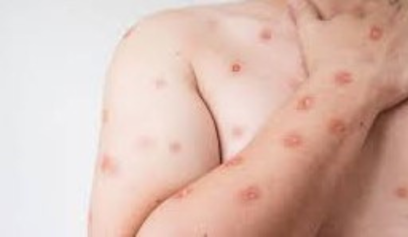 São Paulo confirma caso de mpox com variante mais agressiva e acende alerta